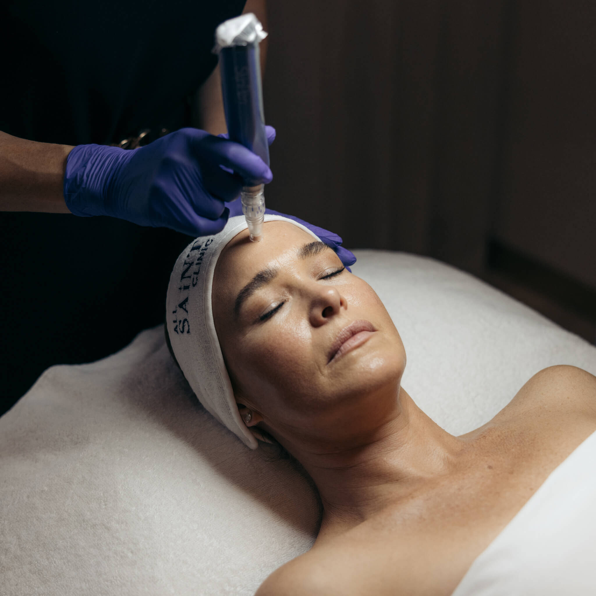 Woman at all saint clinic Sydney experiencing the skin pen microneedling by a trained dermal therapist.