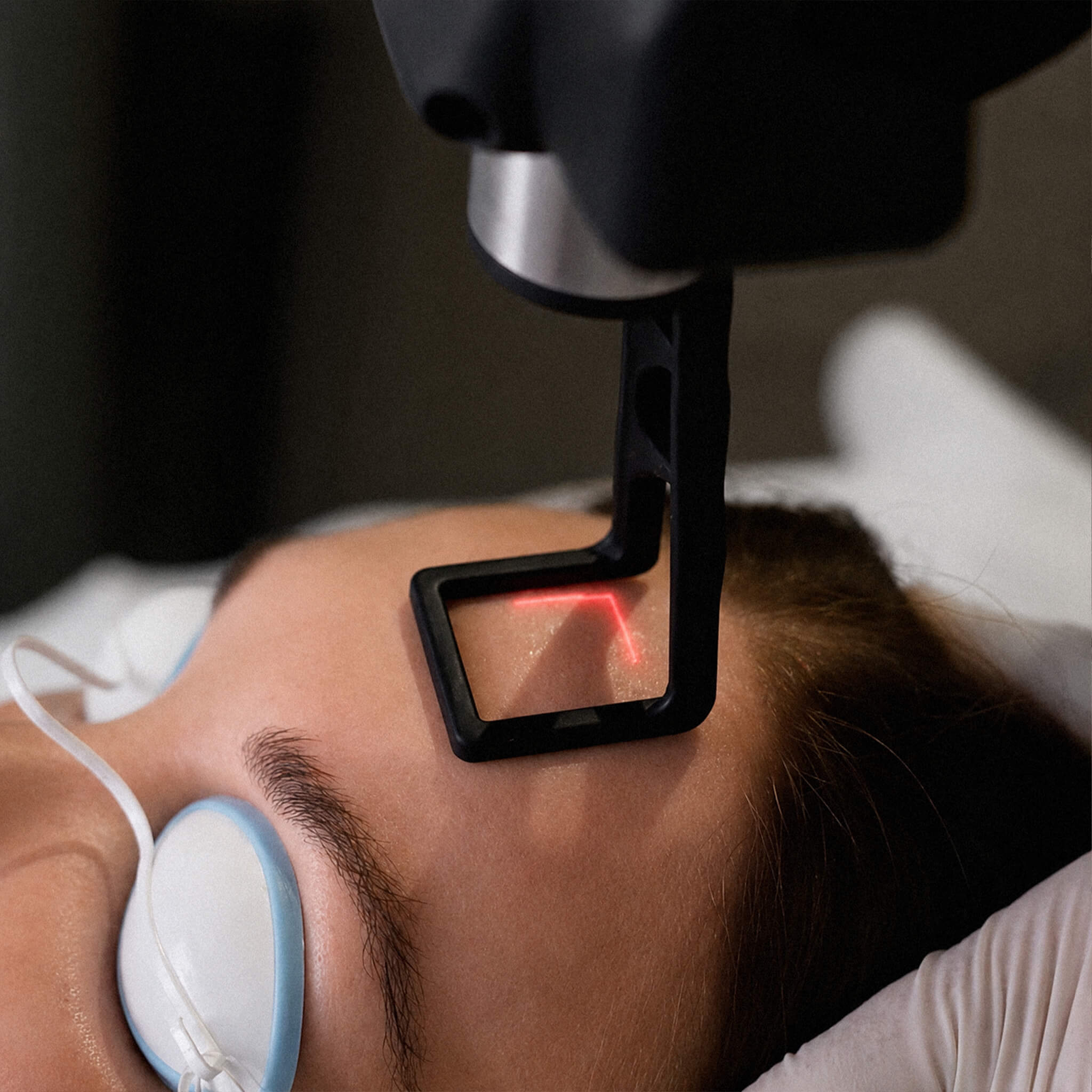 Close up of a woman receiving a CO2 CoolPeel Laser at All Saint Aesthetic Skin Clinic in Sydney by Trained Aesthetic Doctor.